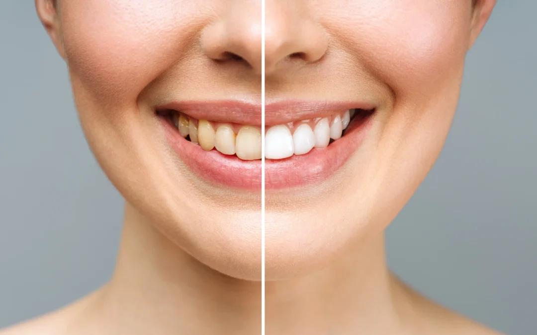 Teeth Whitening in Enfield, CT